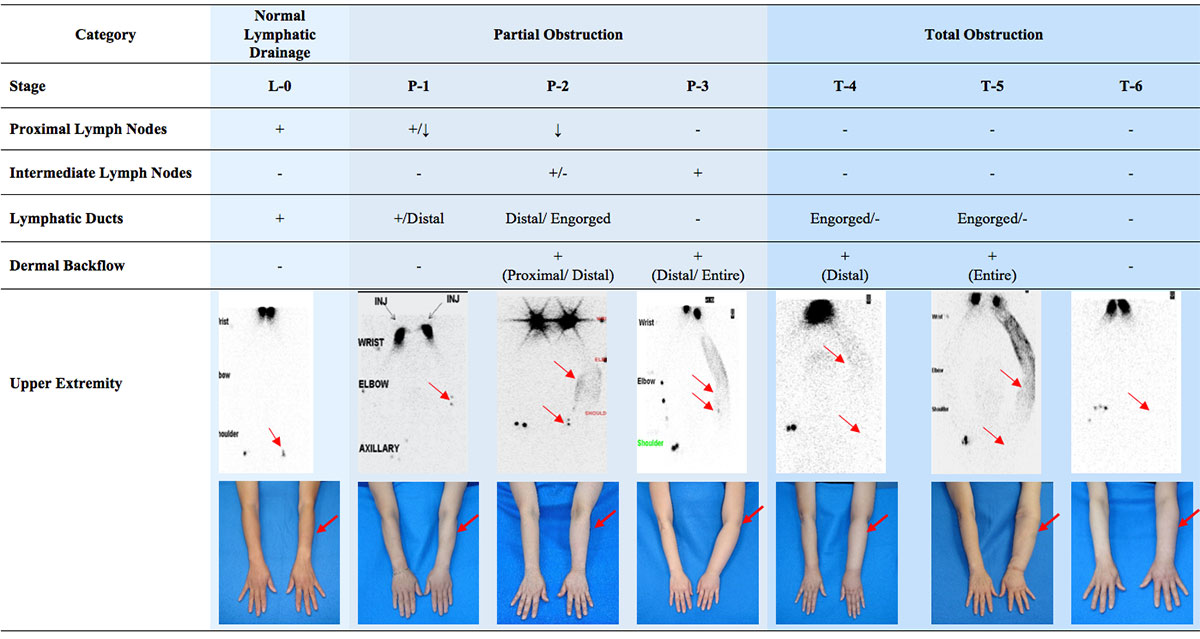Lymphedema Grading Systems - Before Treatment photos and table - patients hands 