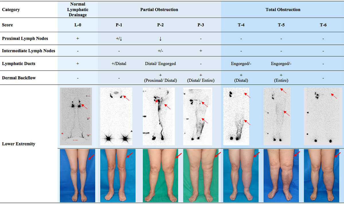 Lymphedema Grading Systems - Before Treatment photos and table - patients legs