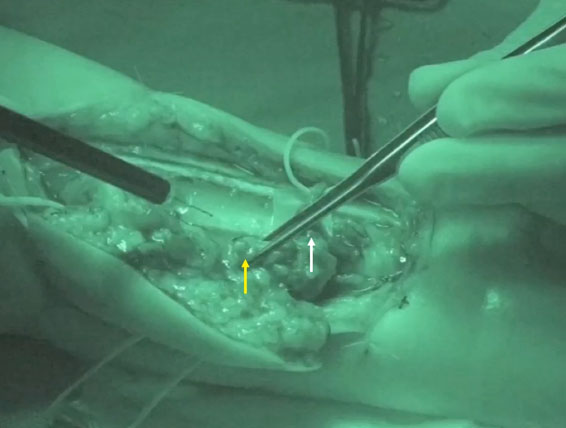 Watch Video - ICG Injection on Lymph Node Directly