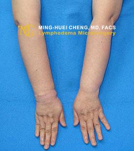 Lymphedema - After Treatment photo - hands, patient 2