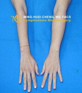 Lymphedema - Before Treatment photo - hands, patient 3