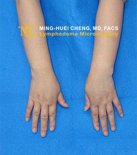 Lymphedema - Before Treatment photo - hands, patient 1