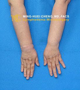 Lymphedema - Before Treatment photo - hands, patient 2