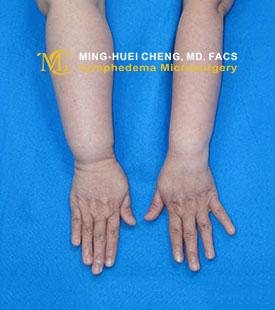 Lymphedema - Before Treatment photo - hands, patient 2