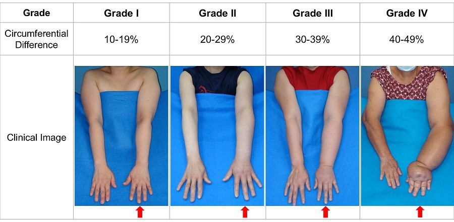Lymphedema Grading Systems - Before Treatment photos - patients hands