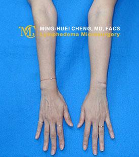 Lymphedema - Before Treatment photo - hands, patient 4