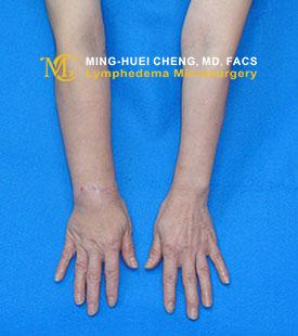 Lymphedema - Before Treatment photo - hands, patient 1