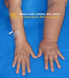 Lymphedema - Before Treatment photo - hands, patient 3