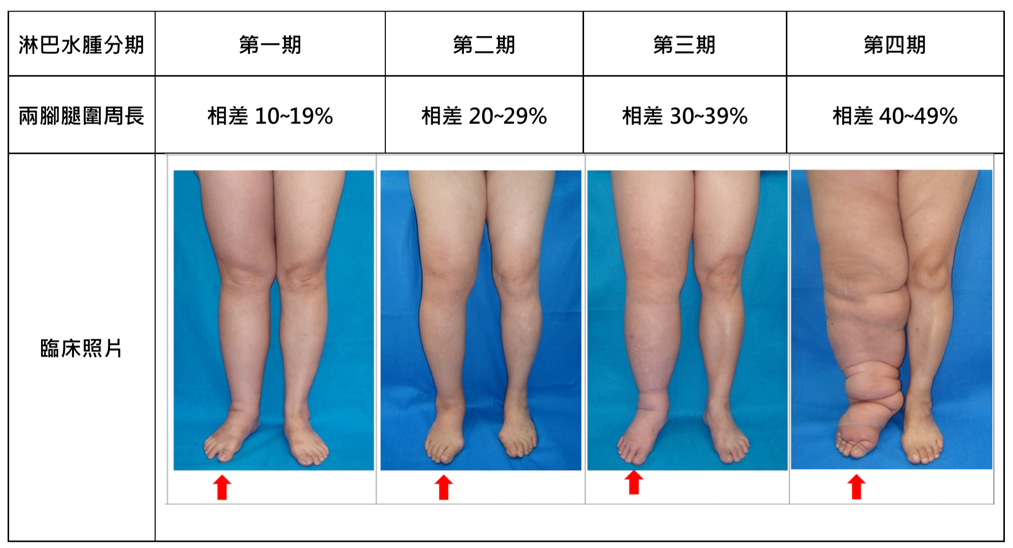 Lymphedema Grading Systems - Before Treatment photos - patients legs