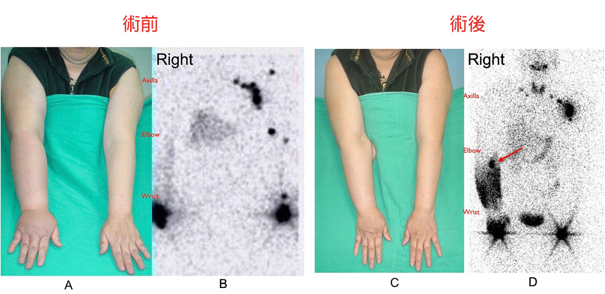 Before and After - 68-year-old female patient who was a victim of right upper limb lymphedema underwent vascularized groin lymph node flap transfer to right elbow